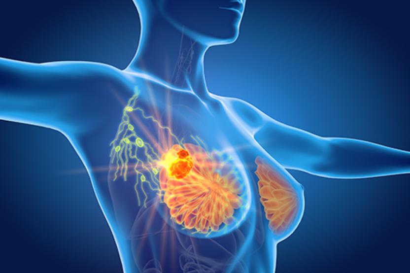 Breast cancer with lymphatics medical illustration